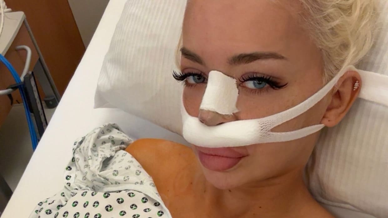 Katja Krasavice erhält bei vierter Nasen-OP Rippenstück als Stütze